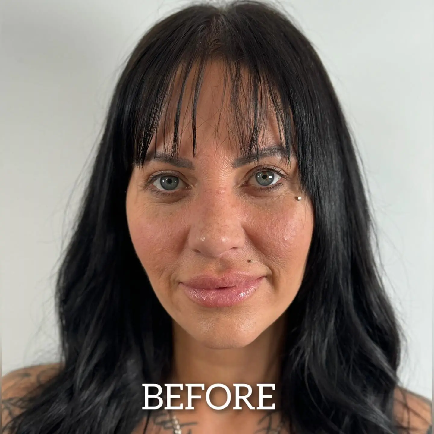 Fox Eyes Treatment - Before and After Image 2