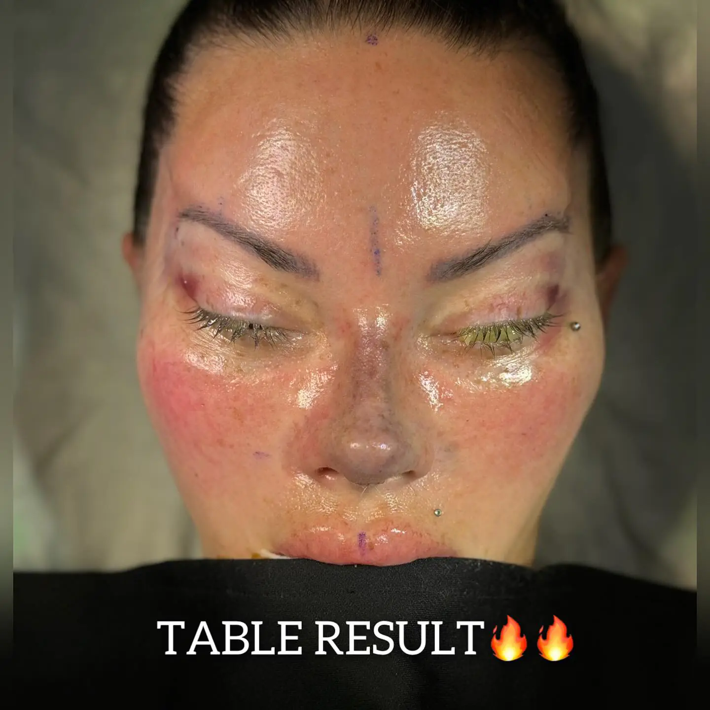 Fox Eyes Treatment - Before and After Image 3