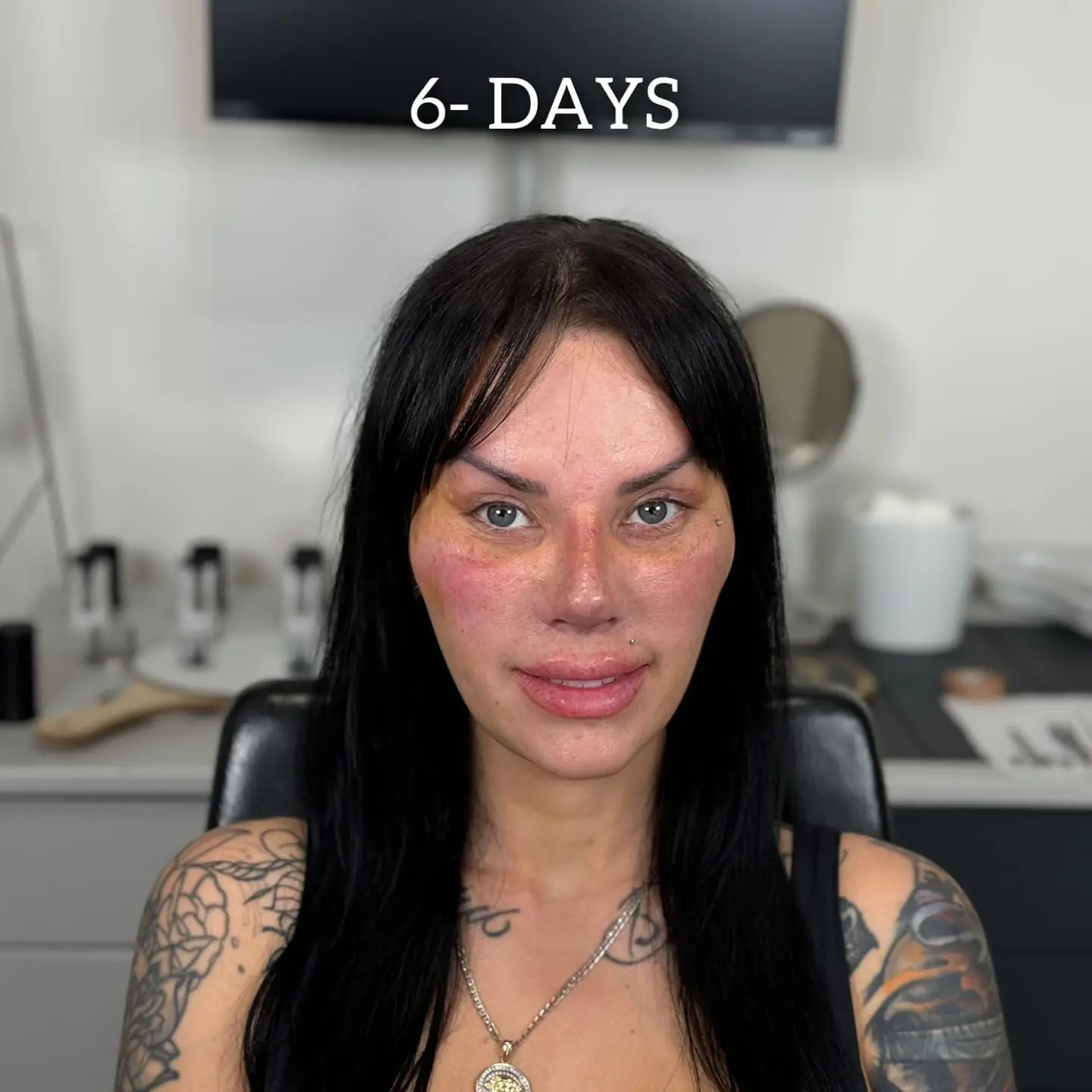 Fox Eyes Treatment - Before and After Image 4