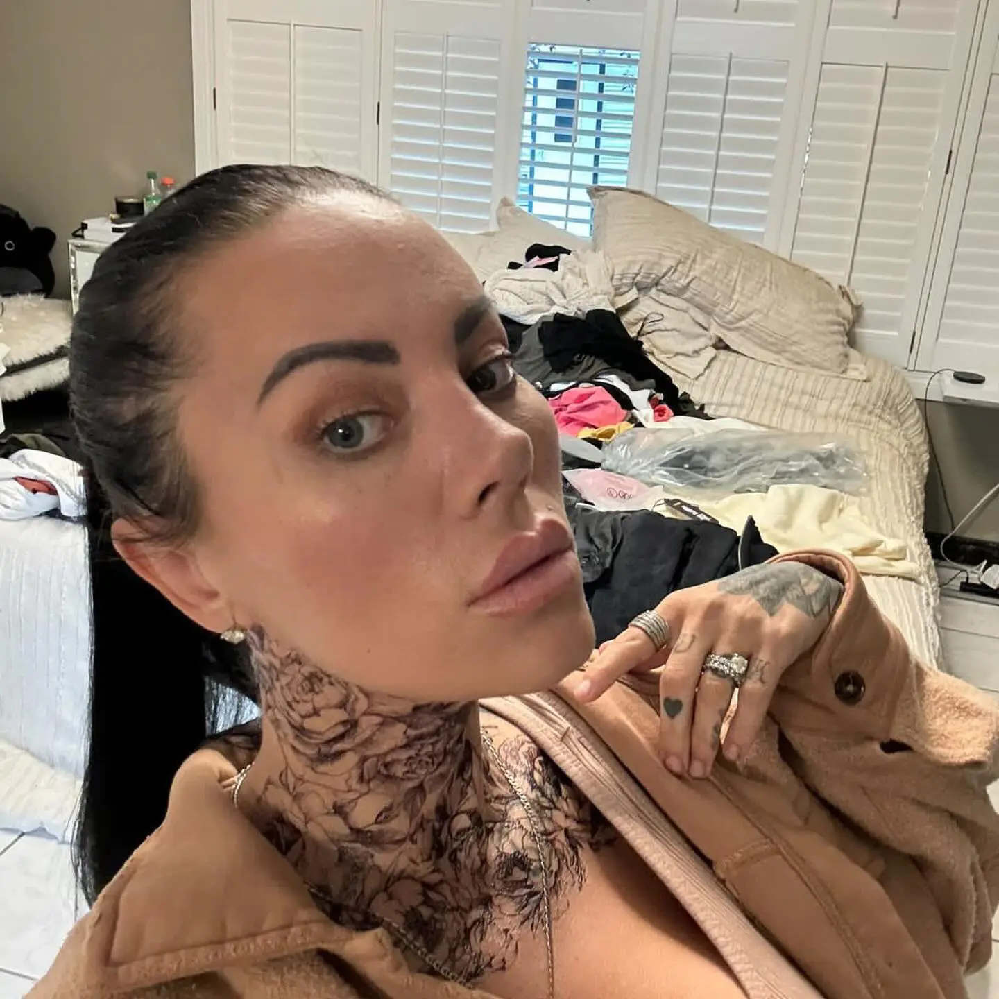 Fox Eyes Treatment - Before and After Image 5