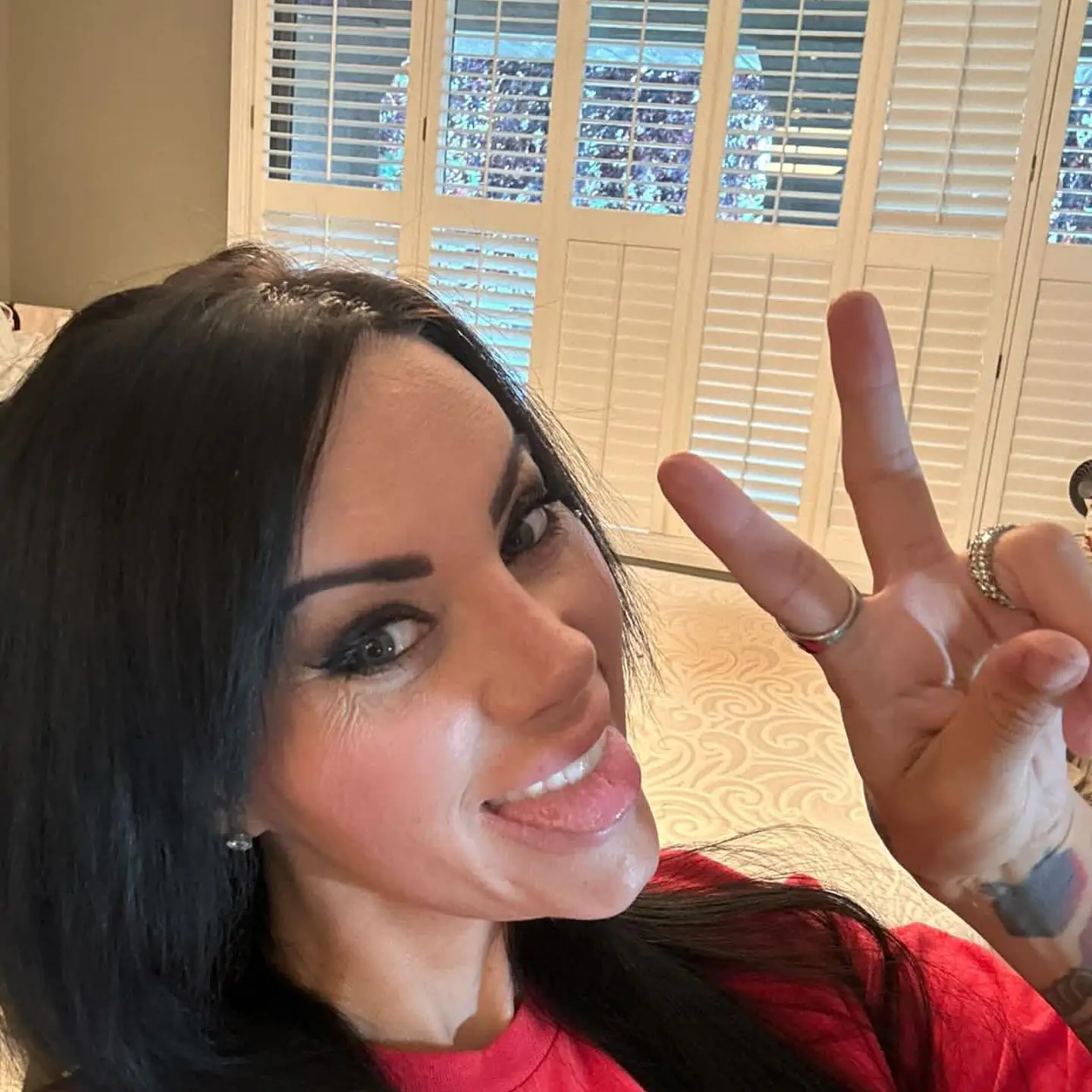 Fox Eyes Treatment - Before and After Image 7