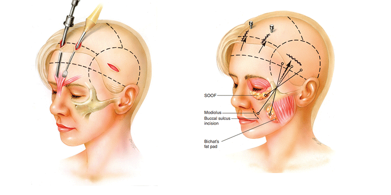 Lifting Endoscópico de la Zona Media de la Cara en Turquí